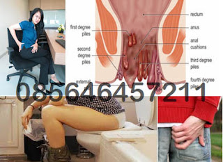 Artikel Obat AmbeJOSS Buat Wasir Internal Prolaps