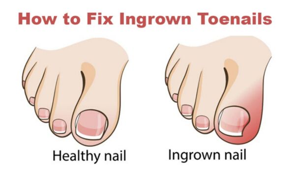 How to Get Rid of Ingrown Toenails with 10 Home Remedies