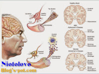 Mengenal Lebih Jauh Penyakit Alzheimer