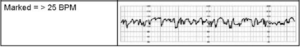 Marked Fetal Heart Rate Monitoring Strip