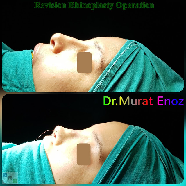 Revision Rhinoplasty Operation in Istanbul, Ethnic Revision Nose Job Turkey