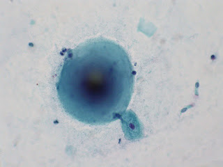 Corpora Amylacea Prostate, Corpora Amylacea Brain, Corpora Amylacea Urine