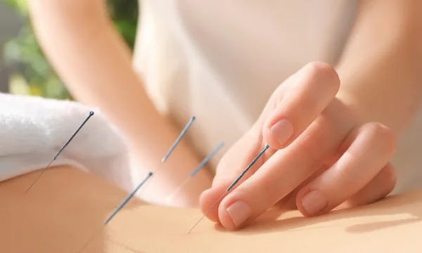 Acupuncture for Holistic Healing