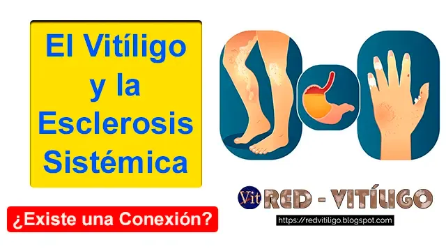 Investigación examina la conexión entre el vitiligo y la esclerosis sistémica.