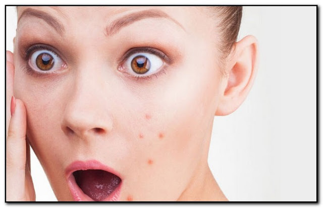 what causes acne on face