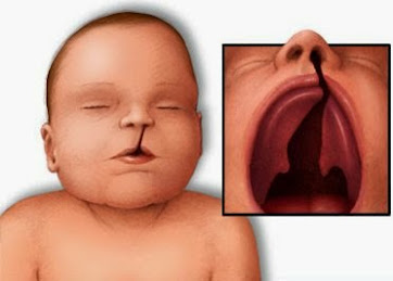 Cleft Lip And Palate