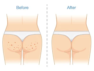 حبوب المؤخره - اسباب وطرق علاج ونصائح دكتوره جنه خداده butt Pimples