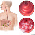 Cara Mengobati Gastritis Kronis yang Aman