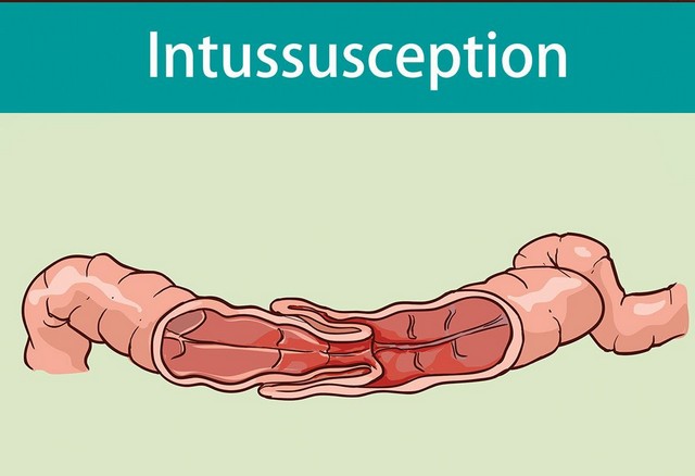 intussuseption-adalah-kelainan-anatomi-usus