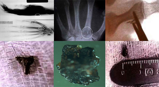 Los Implantes realizados por Alienígenas son un fenómeno mundial, se trata de objetos físicos y pequeños con propiedades de microchips