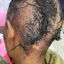Agbako: Wahala as Newlywed Bride suffers severe hair loss and painful scalp burns after she allegedly used fake relaxer [Photos]