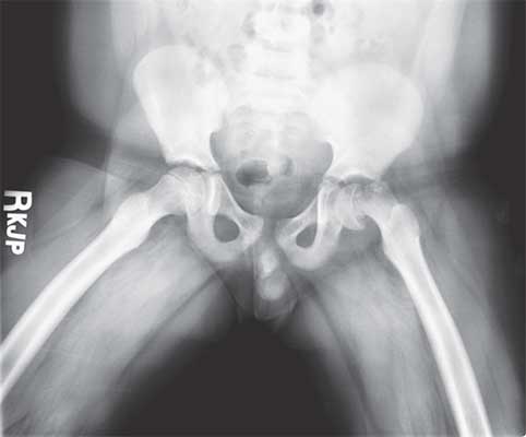 Frog-leg lateral radiograph of the pelvis