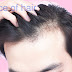 Understanding Male Hair Loss: Causes and Effective Treatments