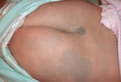 Blue spot on back birthmark