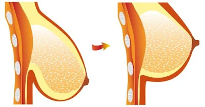 8 Effective Ways To Avoid Breast Sagging