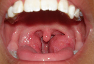 Dr Hassan Medical: Tonsil besar