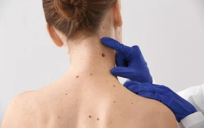 The Ultimate Guide to Mole Removal: Best Methods, Timing, and Aftercare Tips