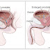 Prostate Cancer: Symptoms, Diagnosis, Prevention, Gay prostate cancer