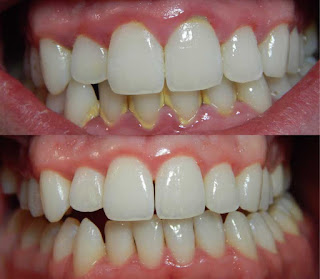 4 Cara Mudah Atasi Karang Gigi Tanpa Harus ke Dokter