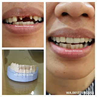 Gambar gigi yang akan memakai gigi crown di permata dental  bali| pasang gigi palsu crown cepat di permata dental  bali | pasang gigi palsu crown bagus di permata dental  bali | pasang gigi palsu crown murah di permata dental  bali | pasang gigi palsu crown aman di permata dental  bali | pasang gigi palsu crown geraham di permata dental  bali | pasang gigi palsu crown mudah di permata dental  bali | pasang gigi palsu crown permanen |harga  pasang gigi palsu crown di permata dental  bali | pasang gigi palsu crown di ahli gigi  permata dental  bali | pasang gigi palsu crown depan di permata dental  bali | pasang crown pada gigi di permata dental  bali | trend foto gambar gigi palsu crown | pasang gigi palsu crown promo di permata dental  bali | pasang gigi Crown 2017 | cara pasang gigi crown di permata dental  bali | sebelum dan sesudah pasang gigi palsu crown di permata dental  bali | pasang gigi palsu permanen bali | pasang gigi palsu permanen banyuwangi | pasang gigi palsu permanen nusa dua | pasang gigi palsu permanen jimbaran | pasang gigi palsu permanen kute | pasang gigi palsu permanen denpasar | pasang gigi palsu permanen badung | pasang gigi palsu permanen denpasar | pasang gigi palsu permanen  singaraja | pasang gigi palsu permanen  balung | pasang gigi palsu permanen murah |  pasang gigi palsu permanen mudah | pasang gigi palsu permanen  cepat | pasang gigi palsu permanen bagus | pasang gigi palsu permanen geraham | pasang gigi palsu permanen depan | pasang gigi palsu bawah | pasang gigi palsu atas | pasang gigi palsu baik| pasang gigi palsu dewasa |