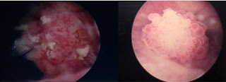 Bladder Cancer Pictures From Cystoscopy