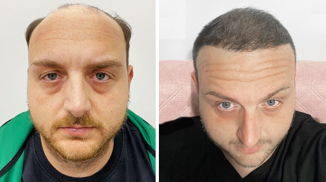 Uomo di 34 anni dopo il trapianto, prima e dopo 9 mesi, metodo Micro FUE