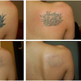 Remove Tattoo Ink From Skin : How Laser Tattoo Removal Works, Learn Laser Tattoo Removal - Remove tattoo ink with fewer treatments.