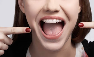 Khi nào áp dụng niềng răng không nhổ răng? 