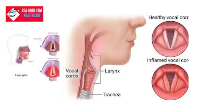 What Is Laryngitis?