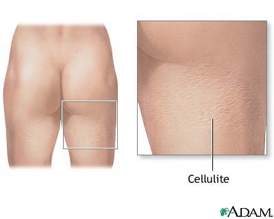 Does Revitol Cellulite Cream Really Work?