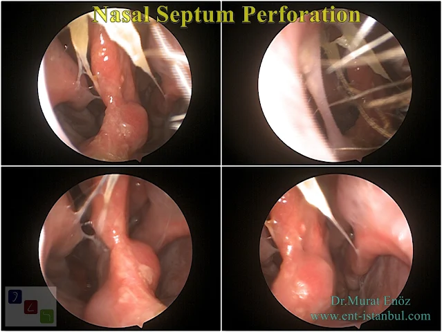 Nasal Septum Perforation