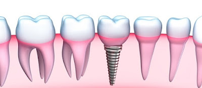 Đánh giá cấy ghép răng implant ở đâu tốt-2