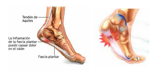 Fascitis plantar