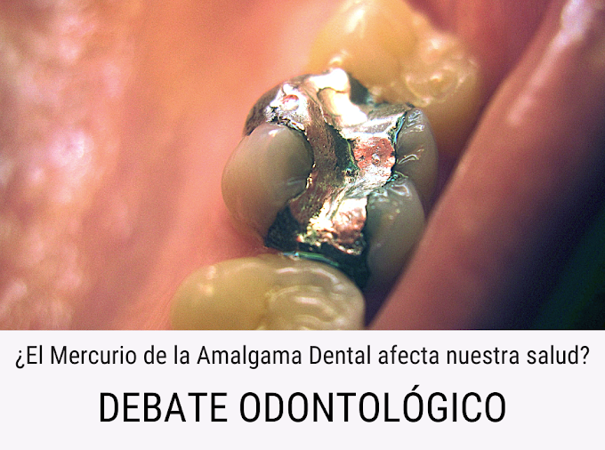 DEBATE ODONTOLÓGICO: ¿El Mercurio de la Amalgama Dental afecta nuestra salud?