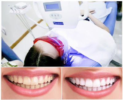Tẩy trắng răng có hại cho sức khỏe không? Tìm hiểu ngay 1