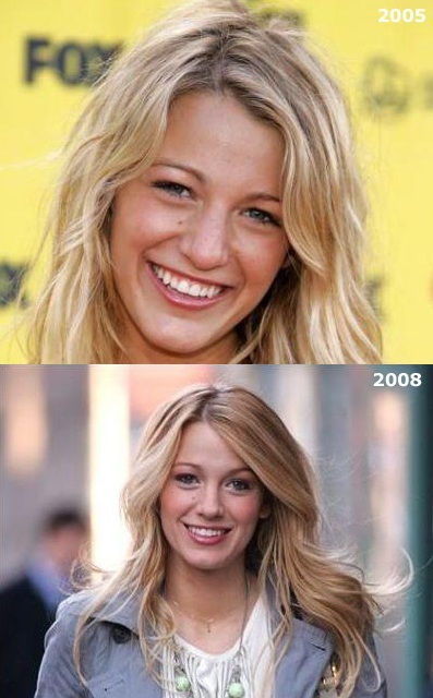 blake lively nose job before. lake lively nose job before