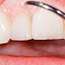 بياض الأسنان - ما الذي يجعل لون الأسنان داكناً؟