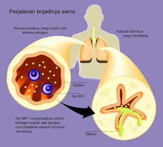 Penyakit Asma