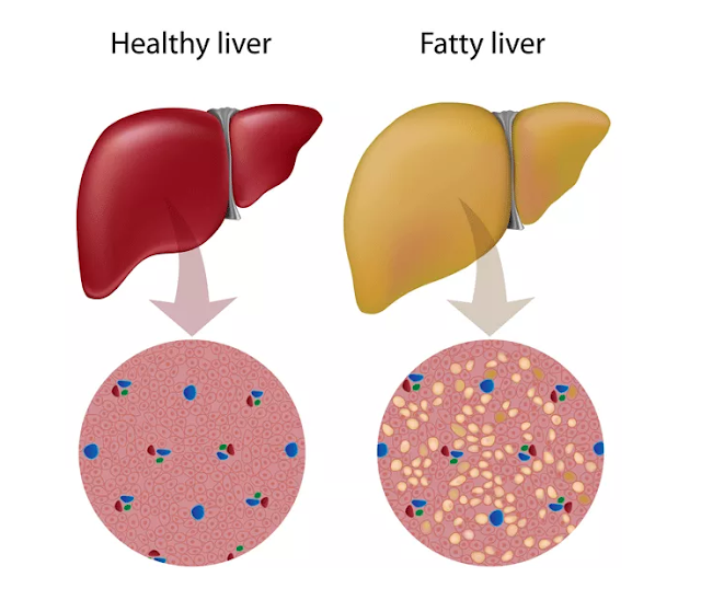 What is Fatty liver?