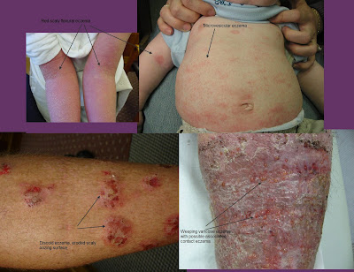 For more information on Eczema View this reference