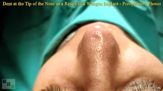 Breathe Implant à Wengen,4. revision nose job, Dent After Rhinoplasty, Complicated 4th Revision Rhinoplasty, Nasal contour irregularities, Postoperative dent issues, Revision rhinoplasty challenges, Rhinoplasty side effects, Nasal structural integrity,