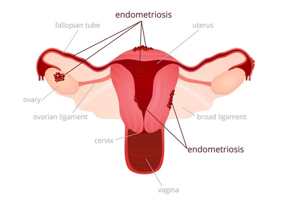 Obat Untuk Penyakit Endometriosis