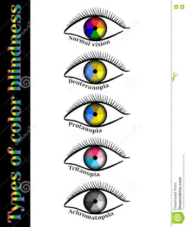   achromatopsie, achromatopsie définition, complete achromatopsia, achromatopsia causes, achromatopsia symptoms, achromatopsia vs color blindness, monochromacy, achromatopsia glasses, achromatopsia treatment