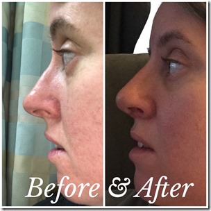 Before and after day 7b