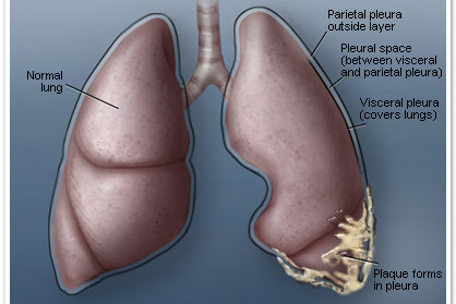 Information about mesothelioma - Tips to Getrid Mesothelioma