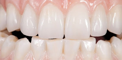 Trồng răng sứ loại nào tốt và độ bền cao?-2