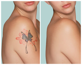 Remove Tattoo, Erase Tattoo, Laser Tattoo