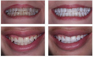 Có nên tẩy trắng răng cho hàm răng trắng sáng?