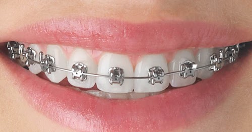 Harga Braces Pendakap Gigi Di Malaysia