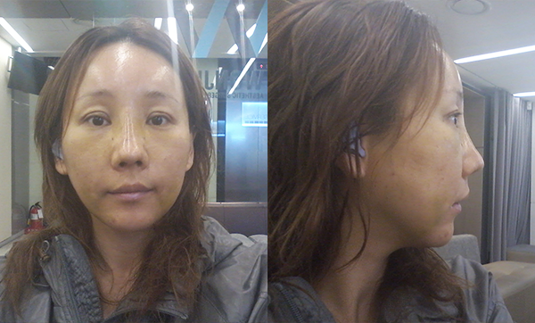 짱이뻐! - Face Lift Surgery, A Drastic Turning Point In My Life